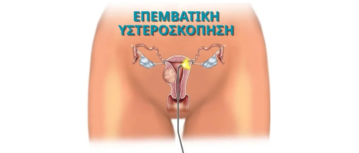 Επεμβατική υστεροσκόπηση – απεικόνιση αφαίρεσης πολύποδα από τη μήτρα